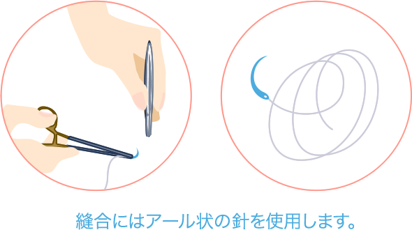 縫合にはアール状の針を使用します。