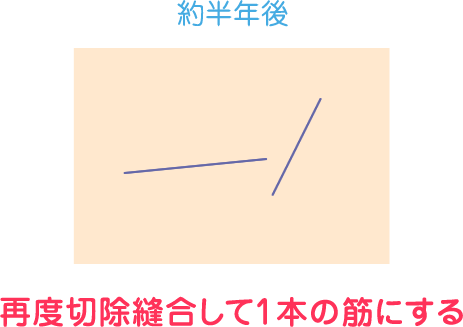 再度切除縫合して1本の筋にする